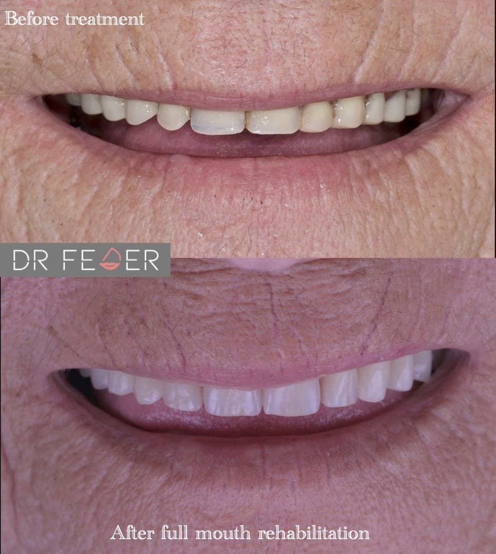 Full-Mouth Rehabilitation