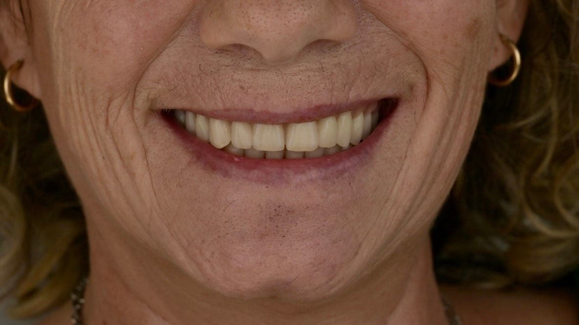 Full-Mouth Rehabilitation