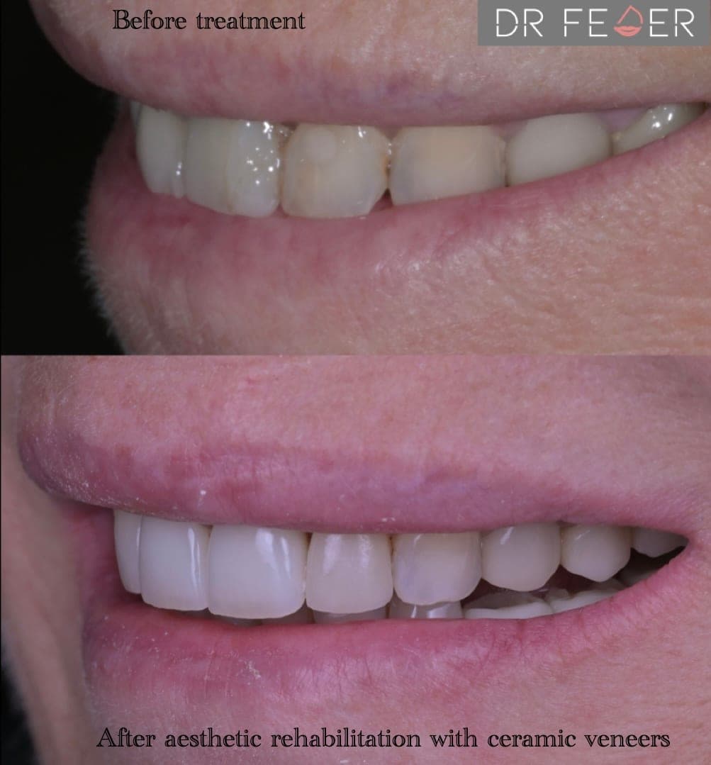 Ceramic Veneers